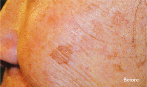 Laser IPL - sun spots before