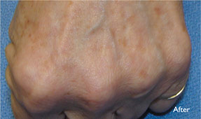 Laser IPL - age spots after