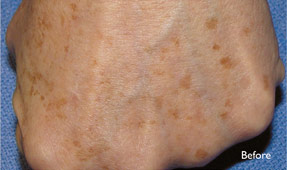 Laser IPL - age spots before