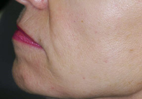 IPL laser treatment - brown spots after