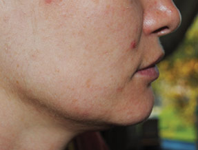 Laser Titan - after