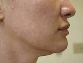 Laser Titan  - before