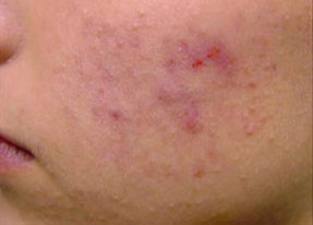 Laser Acne Treatment - acne scars before