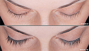 Latisse Before and After