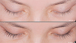 Latisse Before and After