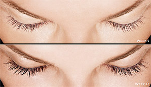 Latisse Before and After