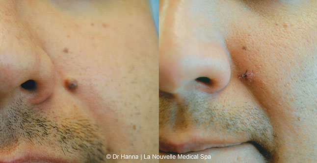Leison and mole removal before after photos by dr. Hanna, La Nouvelle Medical Spa, Oxnard, Ventura County 