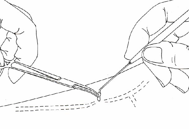 phlebectomy vein removal - pulling the vein with a small hook