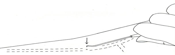 phlebectomy vein removal - tiny incision