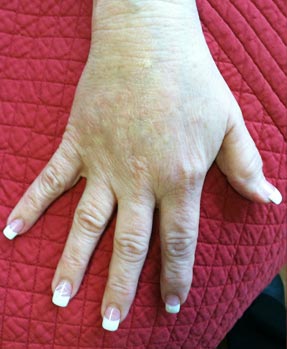 Radiesse  - hand injection before lanouvelle ventura