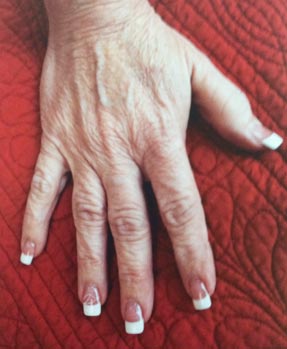 Radiesse  - hand injection before lanouvelle ventura