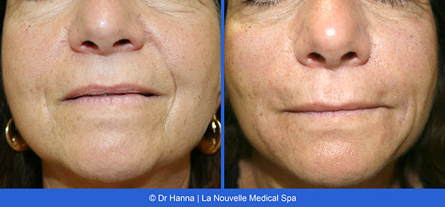 Radiesse, Juvederm, Voluma Before and After photos Ventura County by Dr. Antoine Hanna and Dr. Jack Shenouda, La Nouvelle Medical Spa