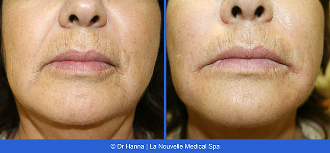 Radiesse, Juvederm, Voluma Before and After photos Ventura County by Dr. Antoine Hanna and Dr. Jack Shenouda, La Nouvelle Medical Spa