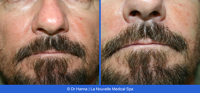 Radiesse, Juvederm, Voluma Before and After photos Ventura County by Dr. Antoine Hanna and Dr. Jack Shenouda, La Nouvelle Medical Spa