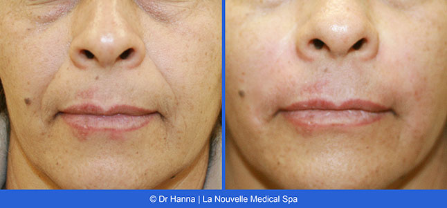 Radiesse, Juvederm, Voluma Before and After photos Ventura County by Dr. Antoine Hanna and Dr. Jack Shenouda, La Nouvelle Medical Spa