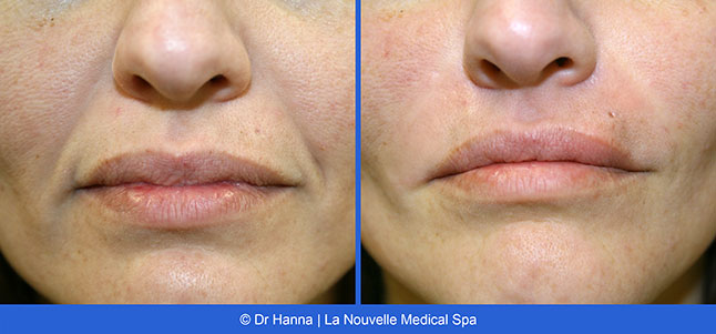 Radiesse, Juvederm, Voluma Before and After photos Ventura County by Dr. Antoine Hanna and Dr. Jack Shenouda, La Nouvelle Medical Spa