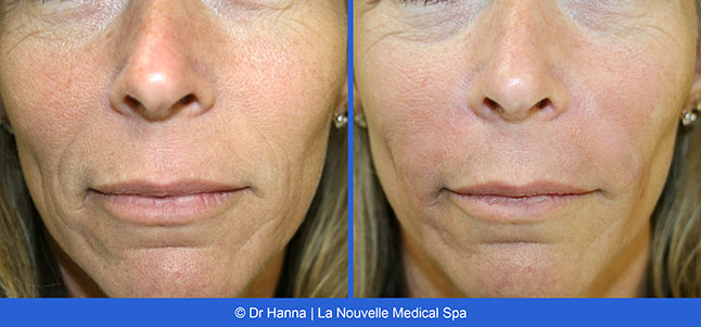 Radiesse, Juvederm, Voluma Before and After photos Ventura County by Dr. Antoine Hanna and Dr. Jack Shenouda, La Nouvelle Medical Spa