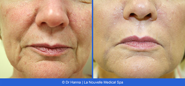 Radiesse, Juvederm, Voluma Before and After photos Ventura County by Dr. Antoine Hanna and Dr. Jack Shenouda, La Nouvelle Medical Spa