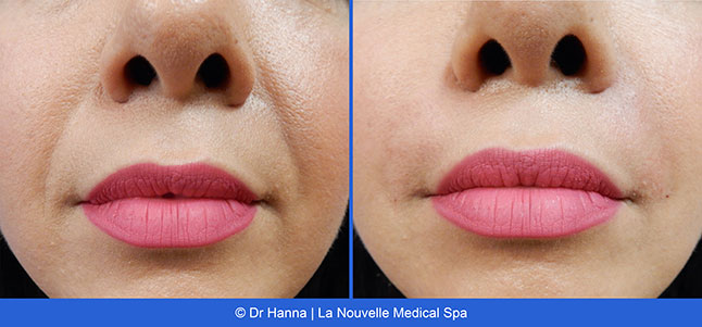 Radiesse, Juvederm, Voluma Before and After photos Ventura County by Dr. Antoine Hanna and Dr. Jack Shenouda, La Nouvelle Medical Spa