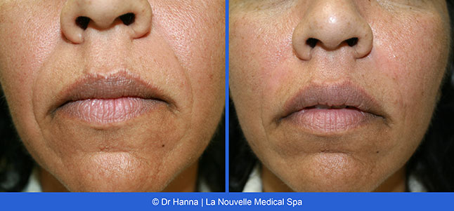 Radiesse, Juvederm, Voluma Before and After photos Ventura County by Dr. Antoine Hanna and Dr. Jack Shenouda, La Nouvelle Medical Spa