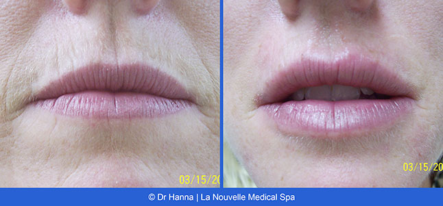 Radiesse, Juvederm, Voluma Before and After photos Ventura County by Dr. Antoine Hanna and Dr. Jack Shenouda, La Nouvelle Medical Spa