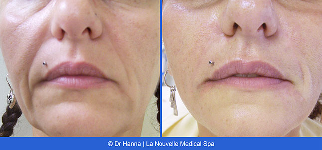 Radiesse, Juvederm, Voluma Before and After photos Ventura County by Dr. Antoine Hanna and Dr. Jack Shenouda, La Nouvelle Medical Spa