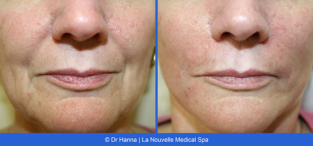 Radiesse, Juvederm, Voluma Before and After photos Ventura County by Dr. Antoine Hanna and Dr. Jack Shenouda, La Nouvelle Medical Spa