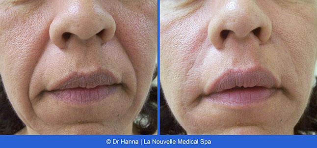 Radiesse, Juvederm, Voluma Before and After photos Ventura County by Dr. Antoine Hanna and Dr. Jack Shenouda, La Nouvelle Medical Spa