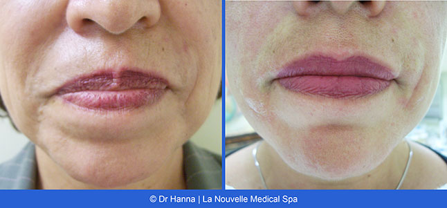 Radiesse, Juvederm, Voluma Before and After photos Ventura County by Dr. Antoine Hanna and Dr. Jack Shenouda, La Nouvelle Medical Spa