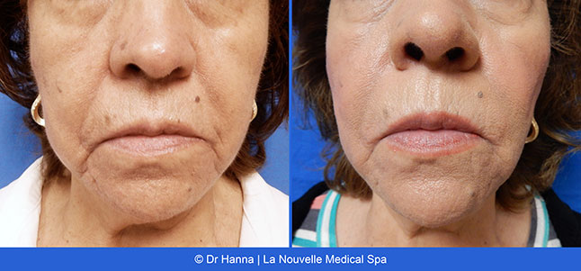 Radiesse, Juvederm, Voluma Before and After photos Ventura County by Dr. Antoine Hanna and Dr. Jack Shenouda, La Nouvelle Medical Spa