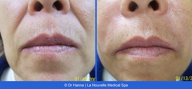 Radiesse, Juvederm, Voluma Before and After photos Ventura County by Dr. Antoine Hanna and Dr. Jack Shenouda, La Nouvelle Medical Spa