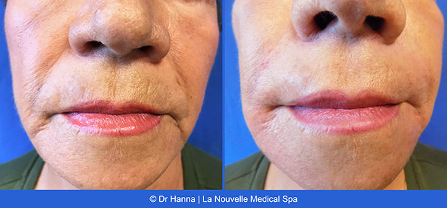 Radiesse, Juvederm, Voluma Before and After photos Ventura County by Dr. Antoine Hanna and Dr. Jack Shenouda, La Nouvelle Medical Spa