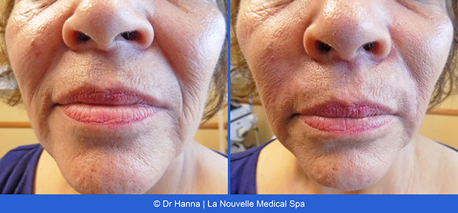 Radiesse, Juvederm, Voluma Before and After photos Ventura County by Dr. Antoine Hanna and Dr. Jack Shenouda, La Nouvelle Medical Spa