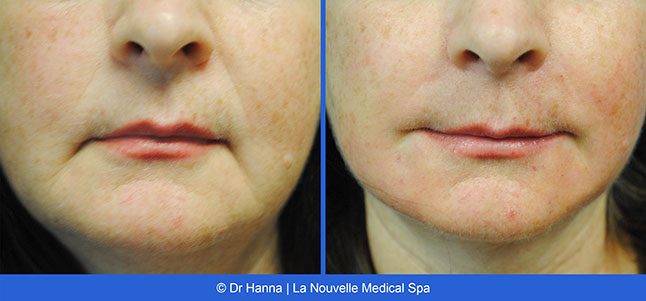 Radiesse, Juvederm, Voluma Before and After photos Ventura County by Dr. Antoine Hanna and Dr. Jack Shenouda, La Nouvelle Medical Spa