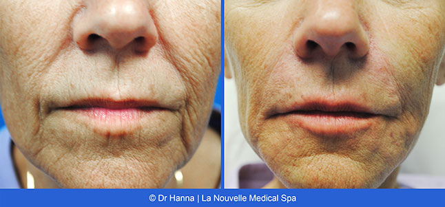 Radiesse, Juvederm, Voluma Before and After photos Ventura County by Dr. Antoine Hanna and Dr. Jack Shenouda, La Nouvelle Medical Spa