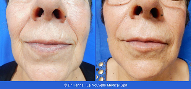 Radiesse, Juvederm, Voluma Before and After photos Ventura County by Dr. Antoine Hanna and Dr. Jack Shenouda, La Nouvelle Medical Spa