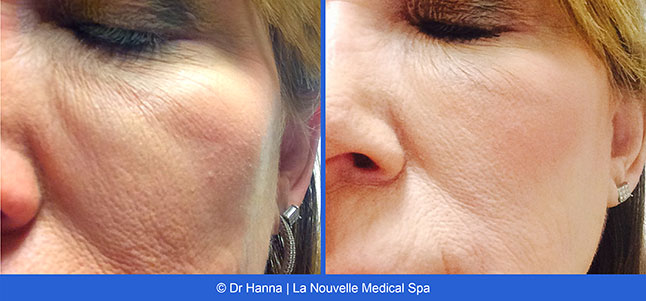 voluma before after photos by dr. Hanna, La Nouvelle Medical Spa, Oxnard, Ventura county  