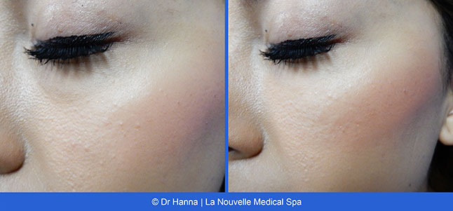 Radiesse, Juvederm, Voluma Before and After photos Ventura County by Dr. Antoine Hanna and Dr. Jack Shenouda, La Nouvelle Medical Spa