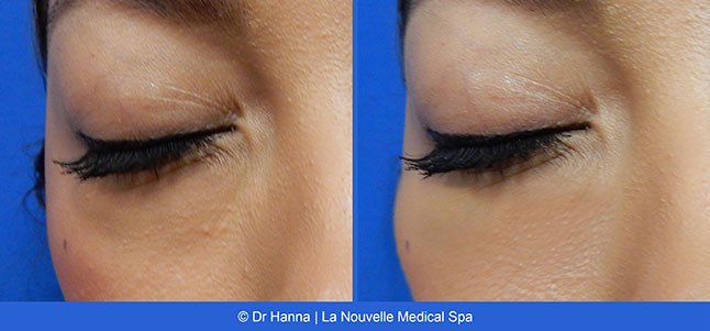 Radiesse, Juvederm, Voluma Before and After photos Ventura County by Dr. Antoine Hanna and Dr. Jack Shenouda, La Nouvelle Medical Spa