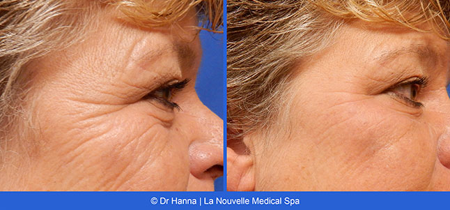 Radiesse, Juvederm, Voluma Before and After photos Ventura County by Dr. Antoine Hanna and Dr. Jack Shenouda, La Nouvelle Medical Spa