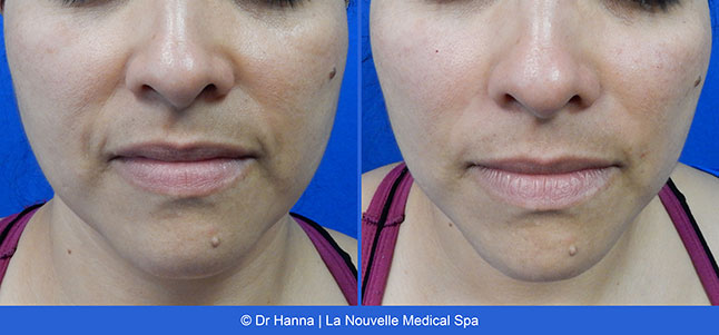 Radiesse, Juvederm, Voluma Before and After photos Ventura County by Dr. Antoine Hanna and Dr. Jack Shenouda, La Nouvelle Medical Spa