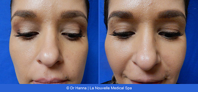 Radiesse, Juvederm, Voluma Before and After photos Ventura County by Dr. Antoine Hanna and Dr. Jack Shenouda, La Nouvelle Medical Spa