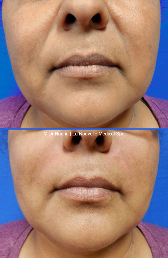 injectable fillers radiesse juvederm before after by dr. hanna la nouvelle medical spa oxnard