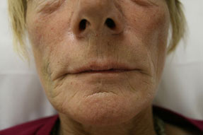 lip enhancement