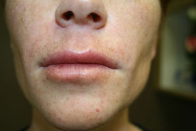 lip enhancement before and after with juvederm and volbella, oxnard