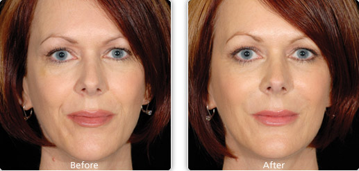 Restylane Nasolabial folds Before and after