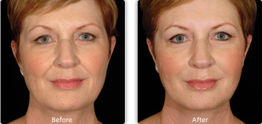 Restylane Before and After
