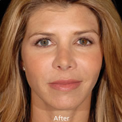 Restylane Wrinkle - after