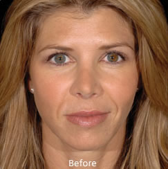 Restylane Wrinkle  - before