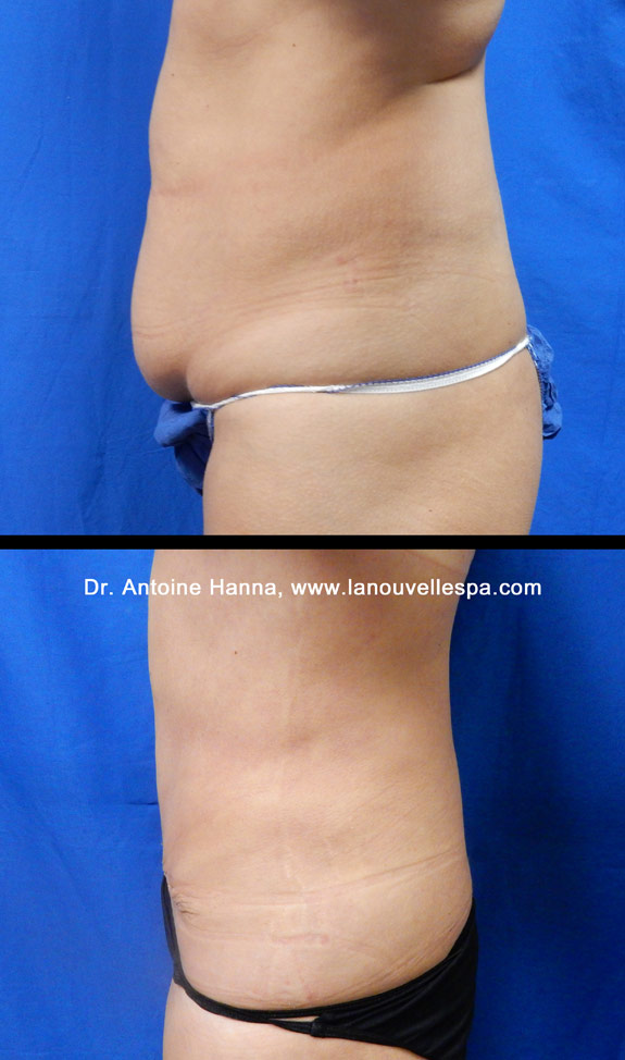 abdominoplasty tummy tuck  before after by dr antoine hanna la nouvelle medical spa ventura